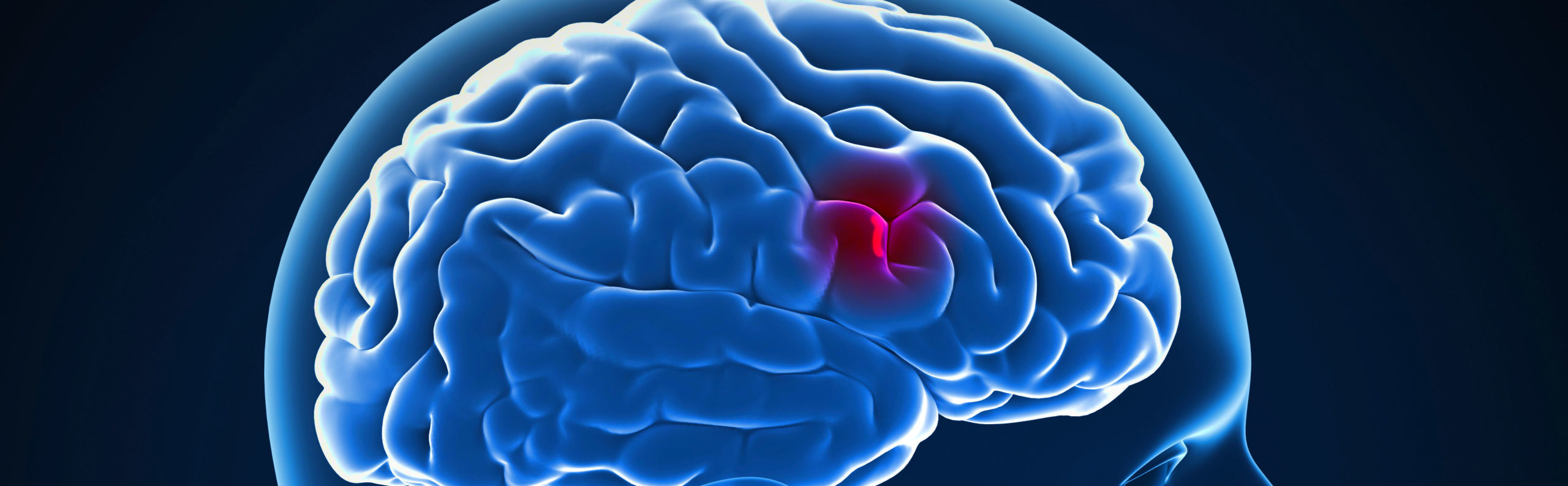 Stroke unit Newcastle Hospitals NHS Foundation Trust