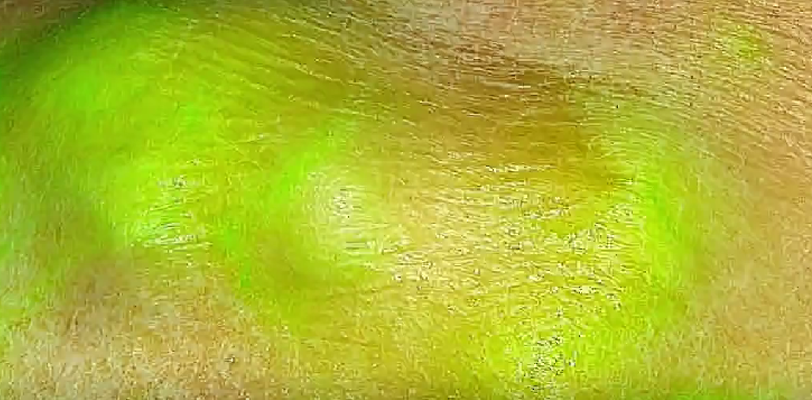 The green dye gathers round the sarcoma under the skin