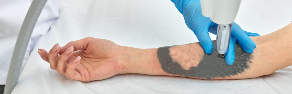 Tattoo removal by laser treatment