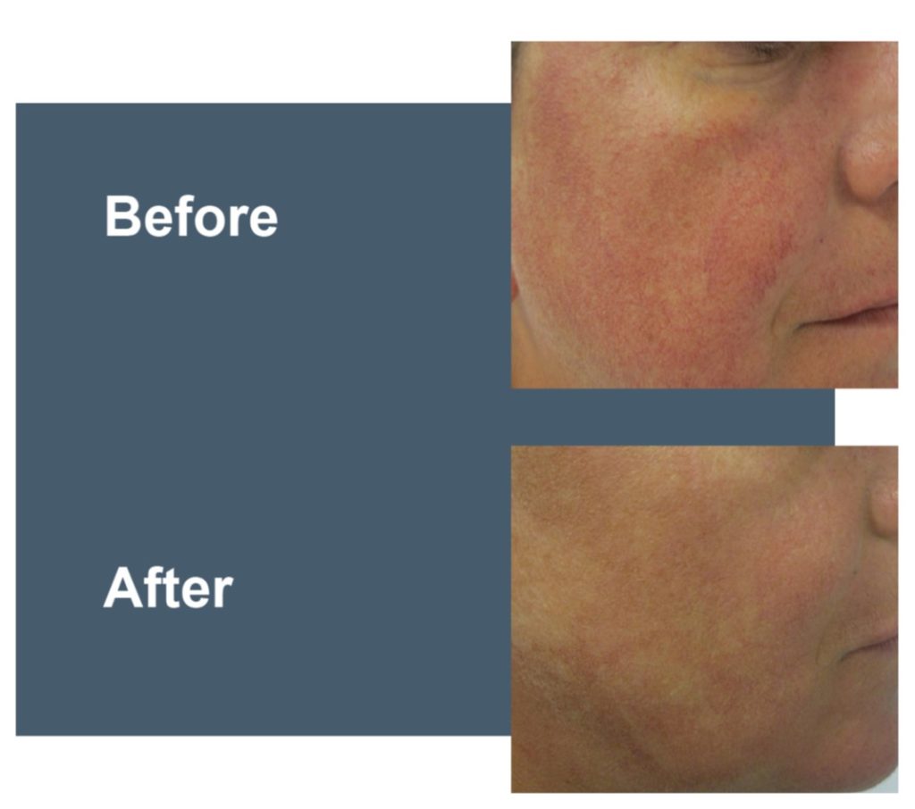 Before and after photos showing the effectiveness of laser treatment to reduce the appearance of broken blood vessels