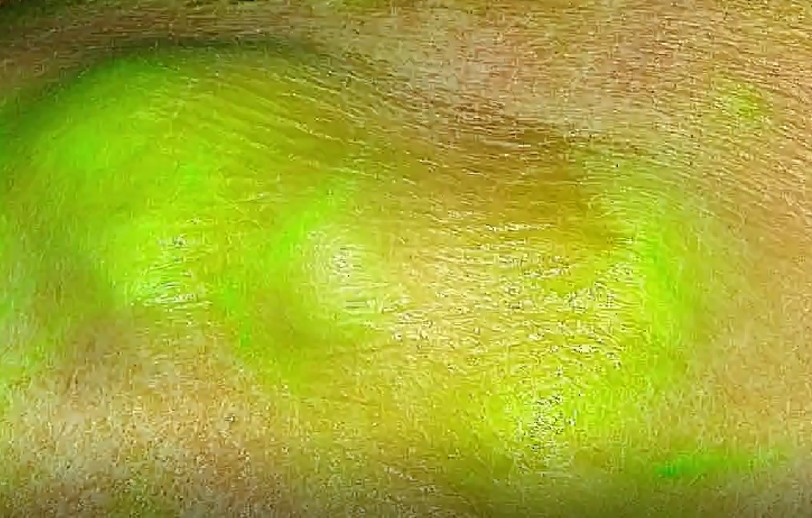 The green dye gathers round the sarcoma under the skin