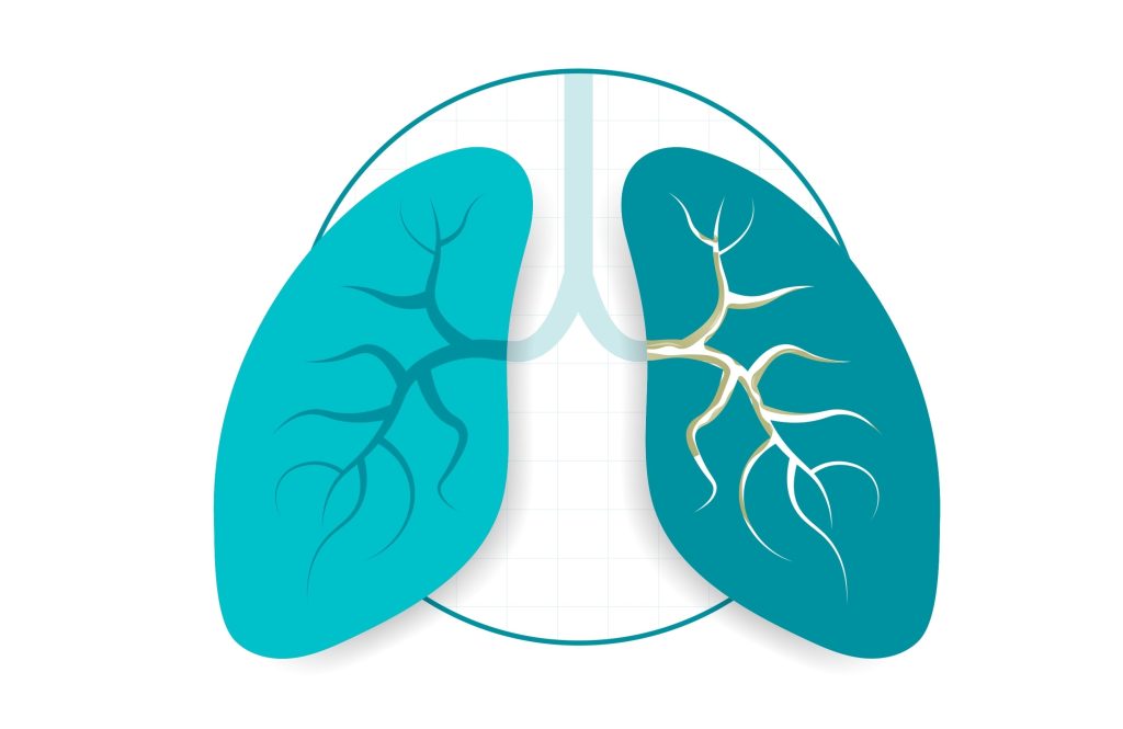 Bronchiectasis is a long-term lung condition with permanent widening of the airways leading to persistent cough and mucus retention which then leads to chest infections. Bronchiectasis affects over 300,000 people in the UK.