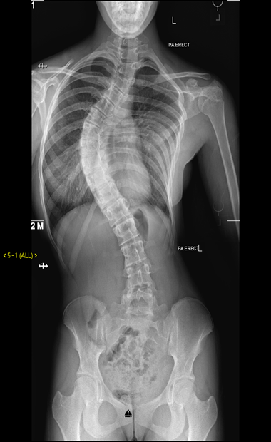 Radiological mage of scoliosis spinal curvature