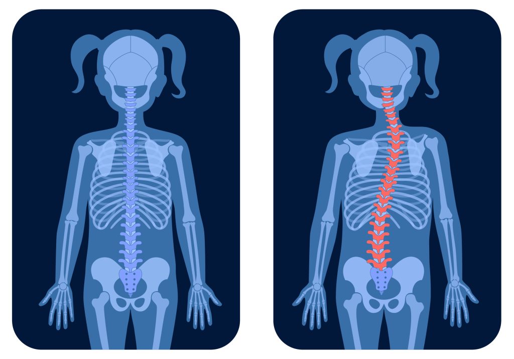 Illustration showing the effects of scoliosis on the spine before and after corrective surgery