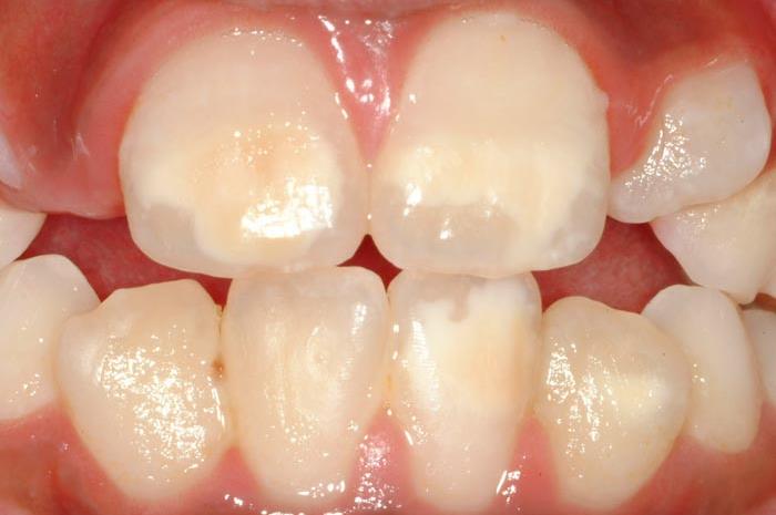 Enamel Hypoplasia In Children