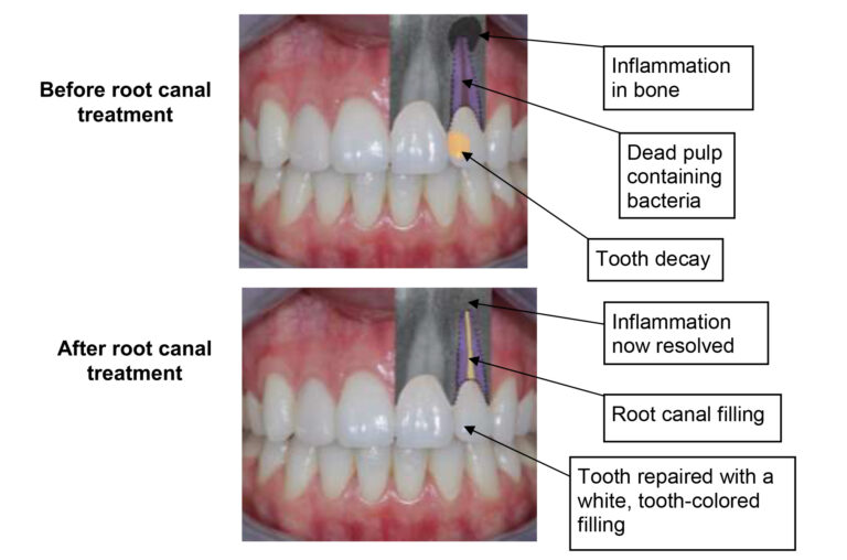 Surgical endodontic/ root canal treatment Newcastle Hospitals NHS
