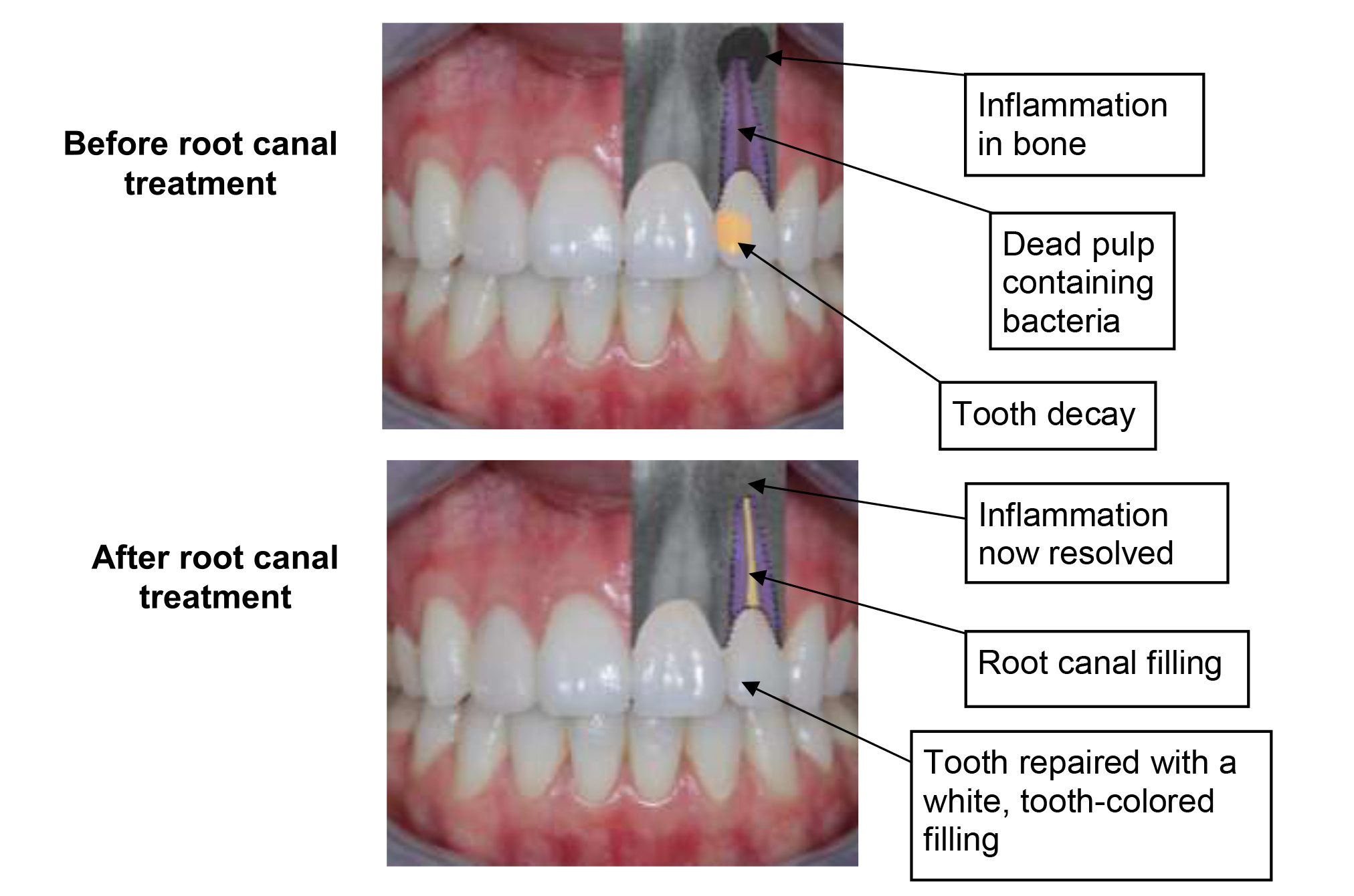 Surgical endodontic/ root canal treatment Newcastle Hospitals NHS