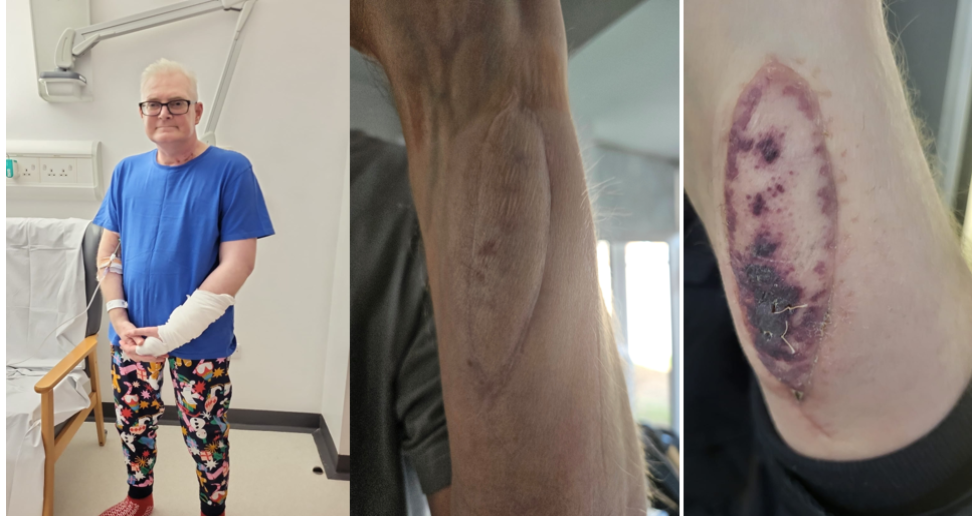 Darren is pictured in hospital with a blue t-shirt and colourful trousers. Two other images show Darren's skin graft and the skin graft turning purple. 