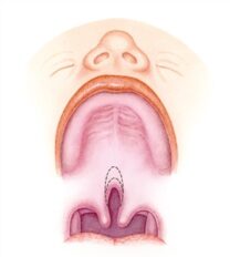 Illustration of cleft of the soft palate