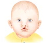 Illustration of a complete cleft of the lip (not involving the alveolus).
