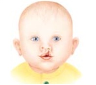 Illustration of an incomplete cleft of the lip.
