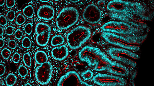 bowel cancer microscope image