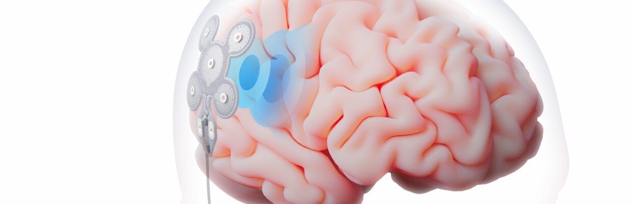 A medical image of a human brain with a device sitting on the head