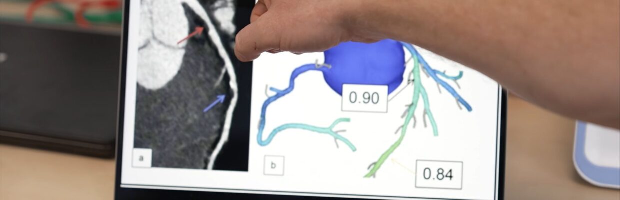 A heartflow scan displayed on a laptop screen