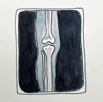 A drawing of an x-ray of the leg