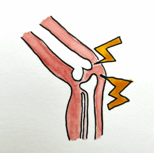 A drawing representing trauma to the knee and bones in the leg