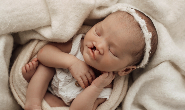 Banner for cleft lip and palate website