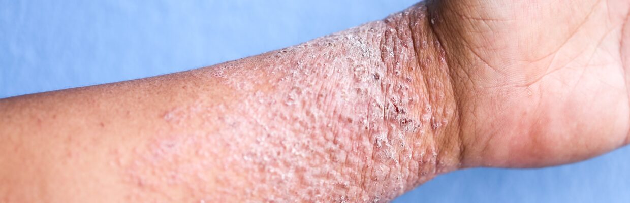 Patient's arm showing signs of eczema