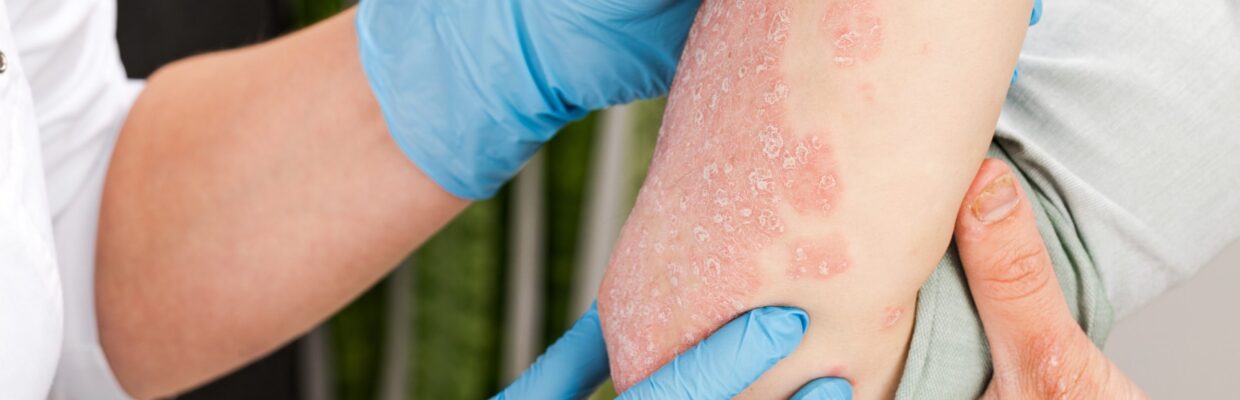 Person's elbow affected by psoriasis