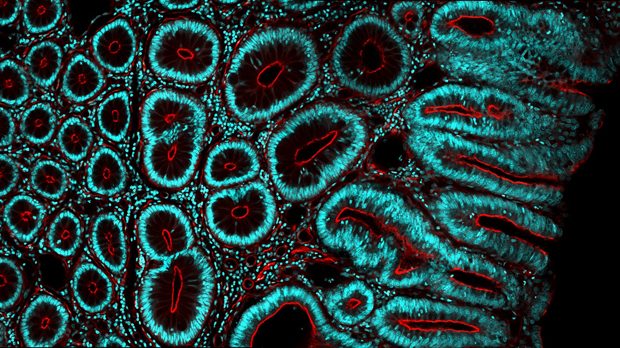 bowel cancer microscope image