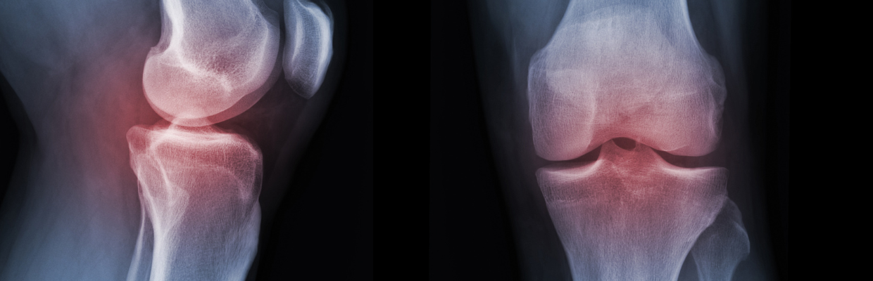 An X-ray image of a persons joints with a red highlight