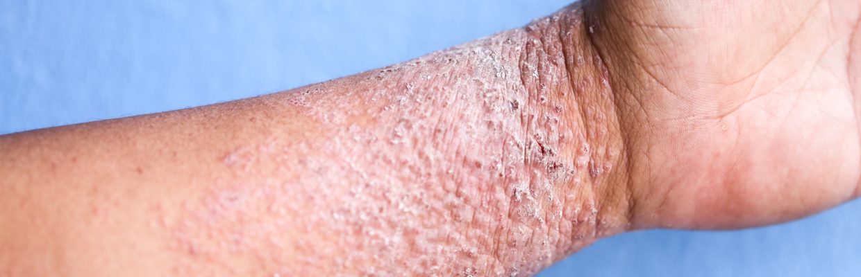 Patient's arm showing signs of eczema